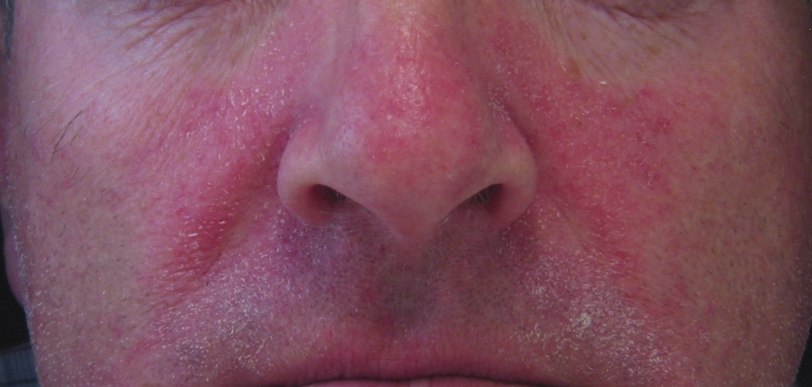 Skin Temple Not Every Red Facial Rash Is Rosacea