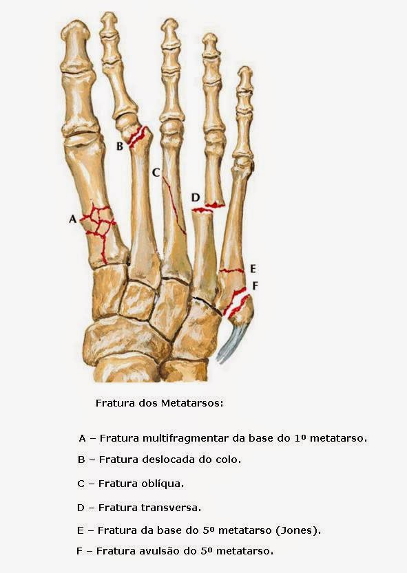 RL Fratura em Base do 5º Metatarso