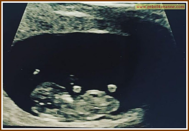 9 Haftalık Gebelik Bebek Ultrason Görüntüsü