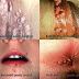 Obat Kutil Kelamin Di Lubang Anus thumbnail