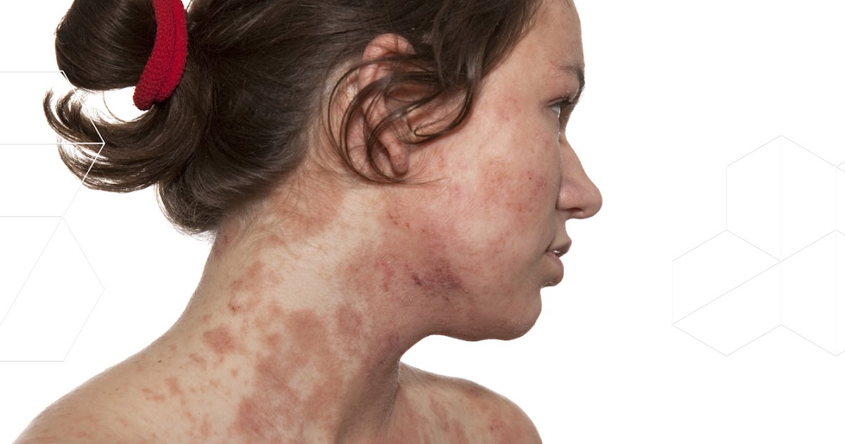 Adult facial eczema