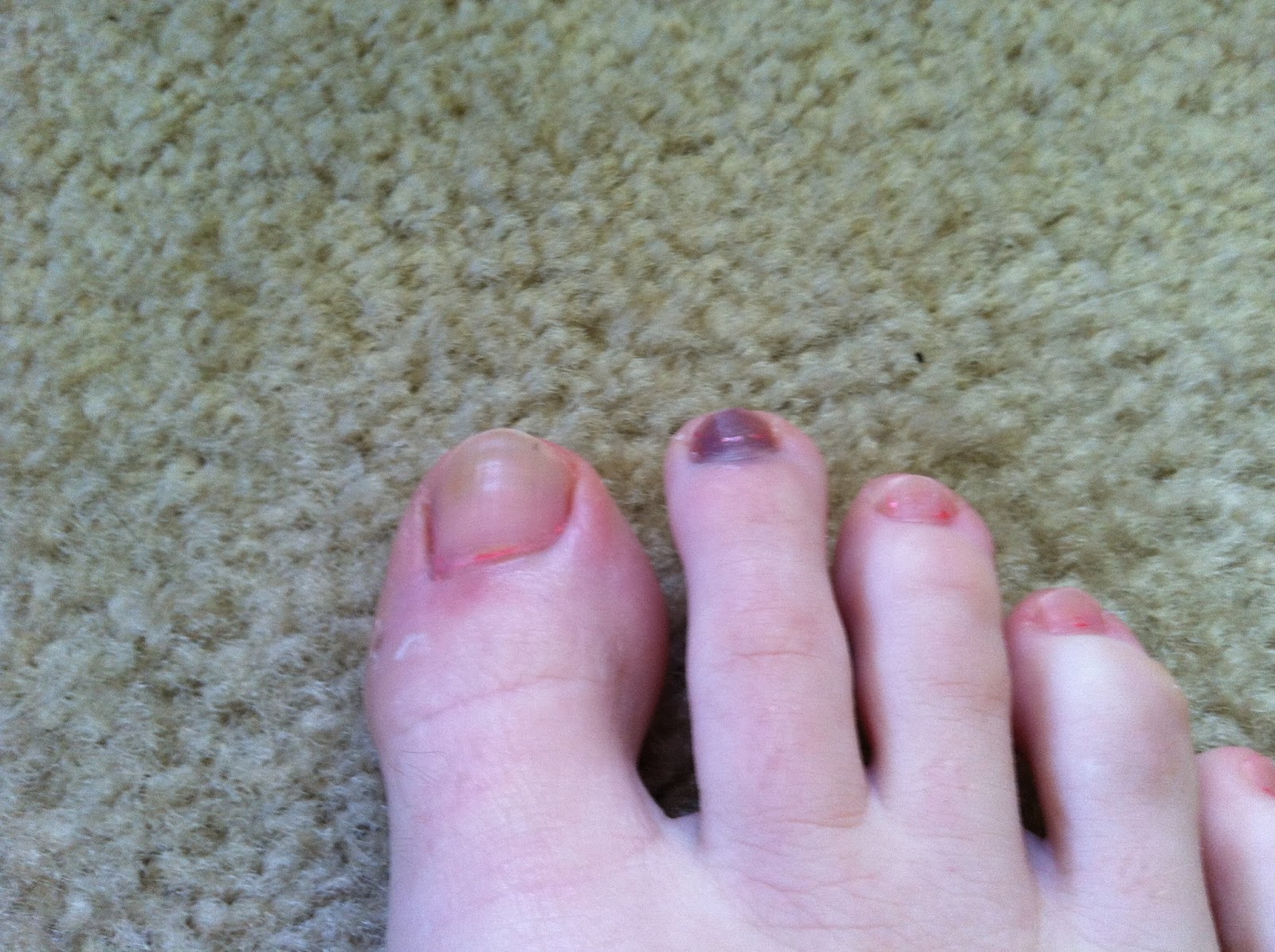 Shave calluses off feet Awesome Nail