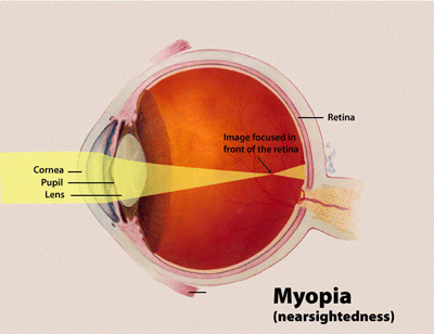 myopia következménye)