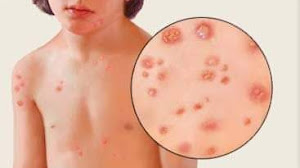 Bolehkah anak cacar mandi? Simak apa kata dokter.