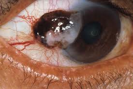 Eye Cancer Picture