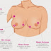 You Should Not Ignore These 4 Breast Changes!