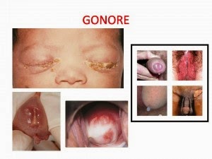mengobati kemaluan bernanah yang parah, nama obat gonore yang aman untuk ibu hamil, Obat Gonore alami