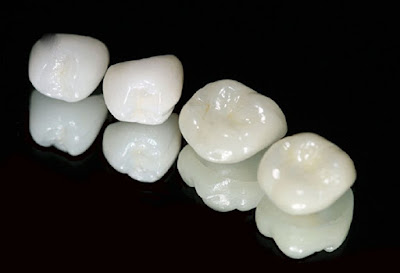 Các loại răng sứ cao cấp hiện nay 