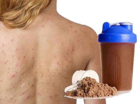 Tomar whey protein en leche causa acné