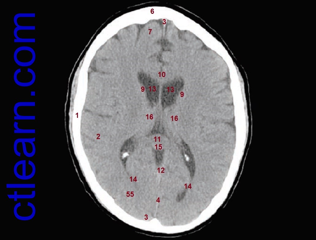 Anatomy CT Axial Brain