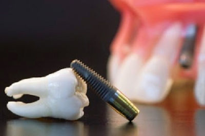 Cấy ghép răng implant đau không?