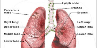 What Is Asbestos Cancer ?