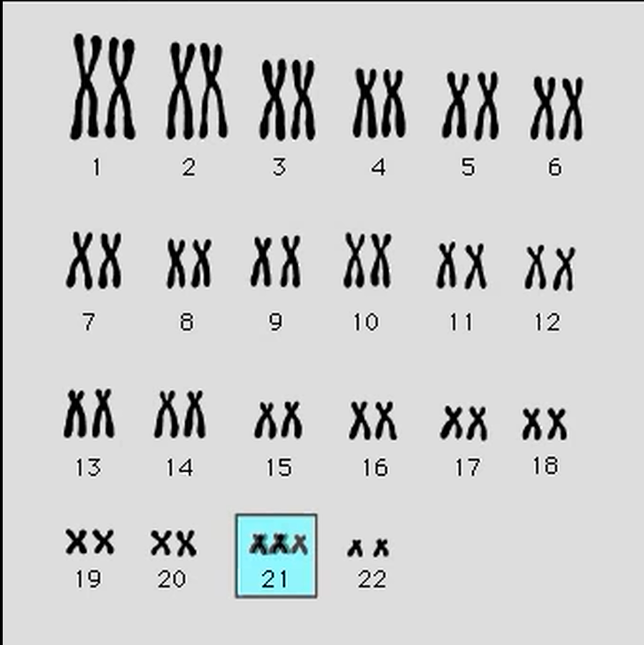 SINDROME DE POTTER ¿ COMO SE DIAGNOSTICA?