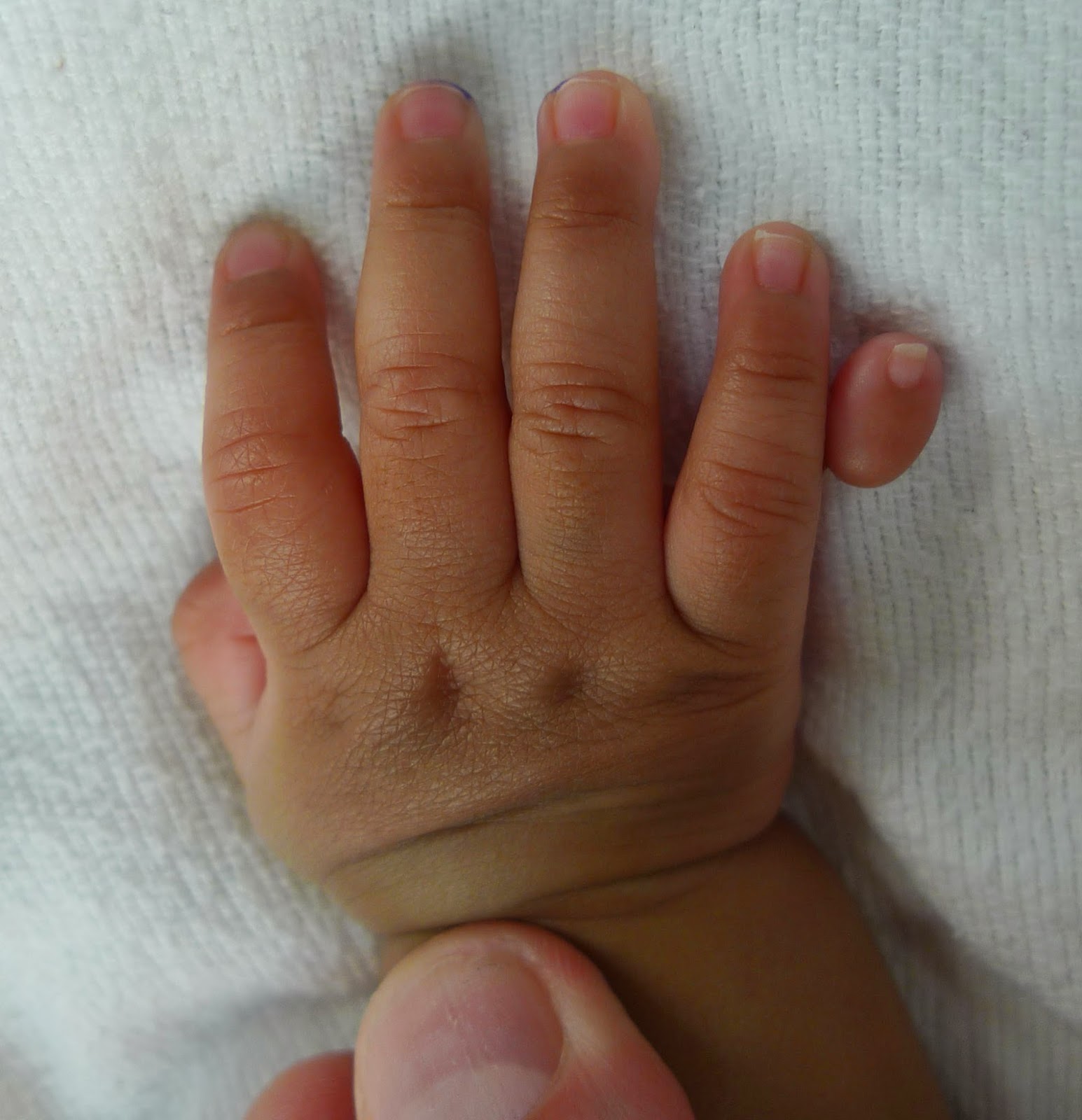 Extra Digits What Happens After Treatment Congenital Hand And Arm Differences Washington