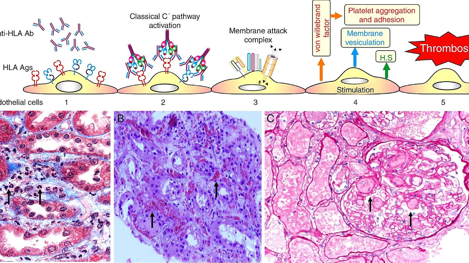 Antibody Mediated Rejection Heart Transplant Hear Choices