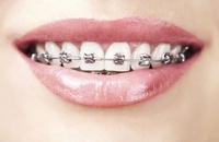 Aparat ortodontyczny - tak czy nie ?