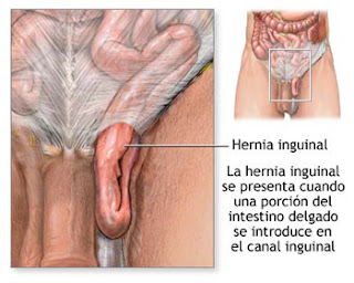 Hernia Inguinal cirugía para corregir en Guadalajara Mexico