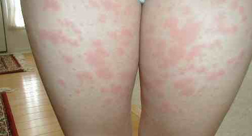 skin rash on thighs #11