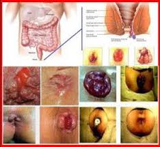 Foto Jenis Obat Ampuh Untuk Penyakit Ambeien Di Apotik