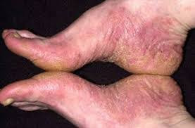 Jual obat eksim untuk mengatasi kulit bintik merah di kaki