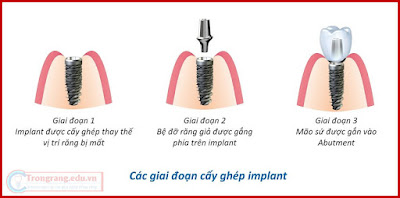 Răng implant giá bao nhiêu?