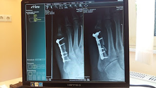 fracture-www.healhtnote25.com