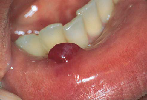 Lip Cyst Treatment - Doctor answers on HealthTap
