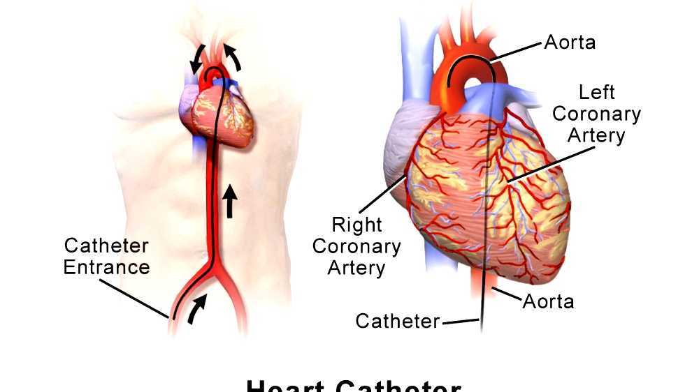 Cardiac catheterization