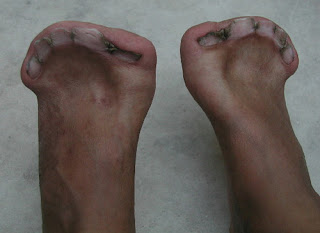 Severely distorted toes in a patient with Apert syndrome photos, pictures