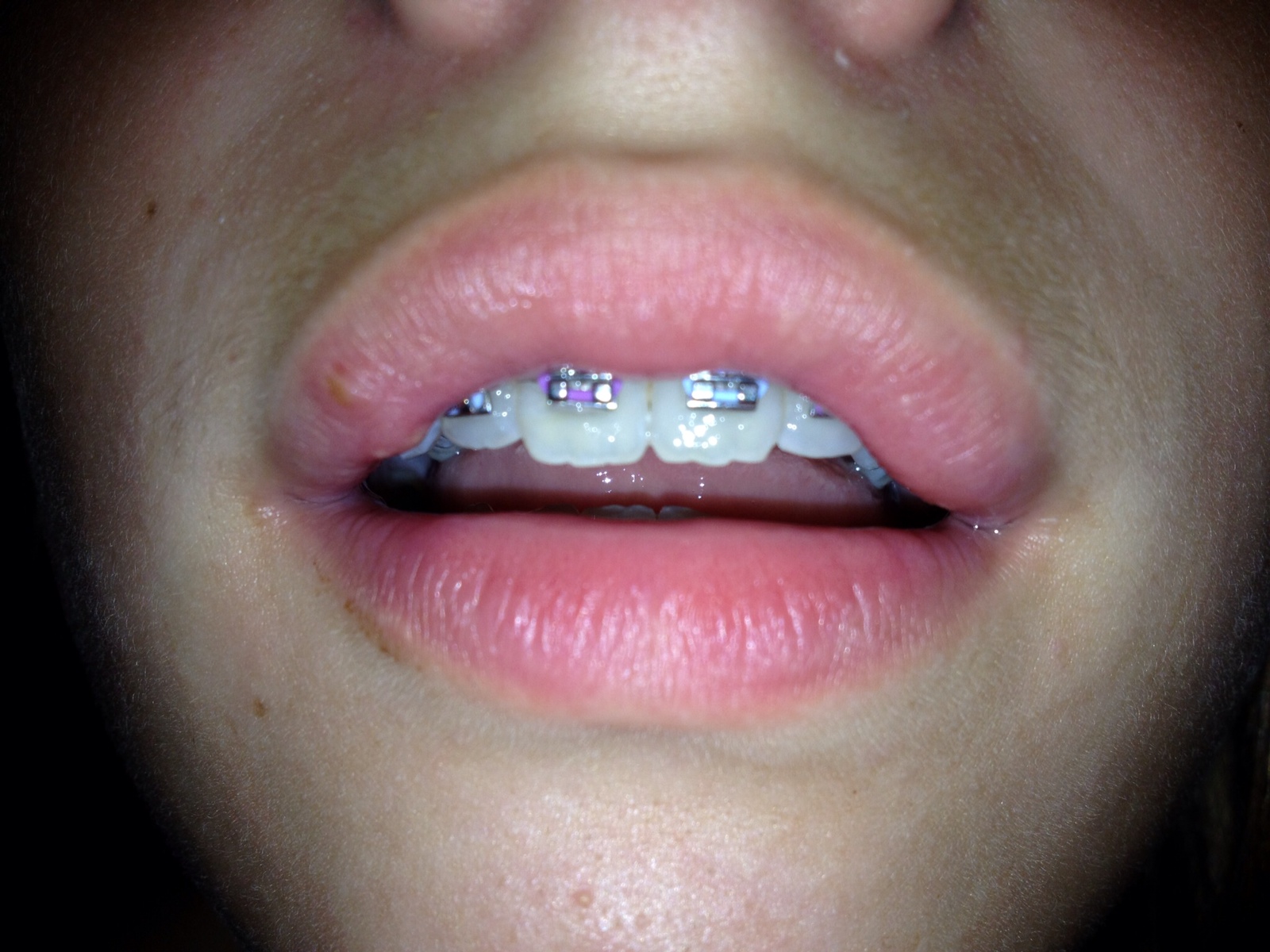 Townsend Topics New Braces, Football Jamboree, and Garage Sale