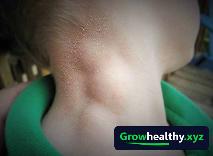 lymphoma diseaseymphoma disease drugs symptoms etc grow healthy