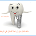 ملف كامل عن زراعة الأسنان في الرياض