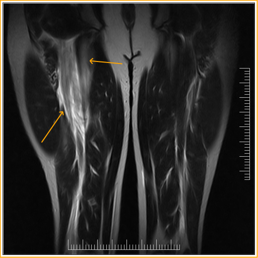 Biceps Femoris Tear Mri Sumers Radiology Blog