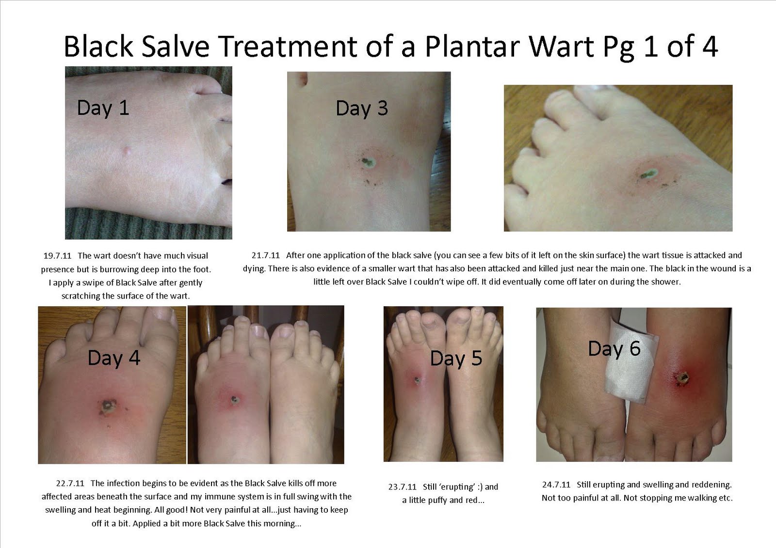 Holistic Therapy Connections Treatment of a Plantar Wart