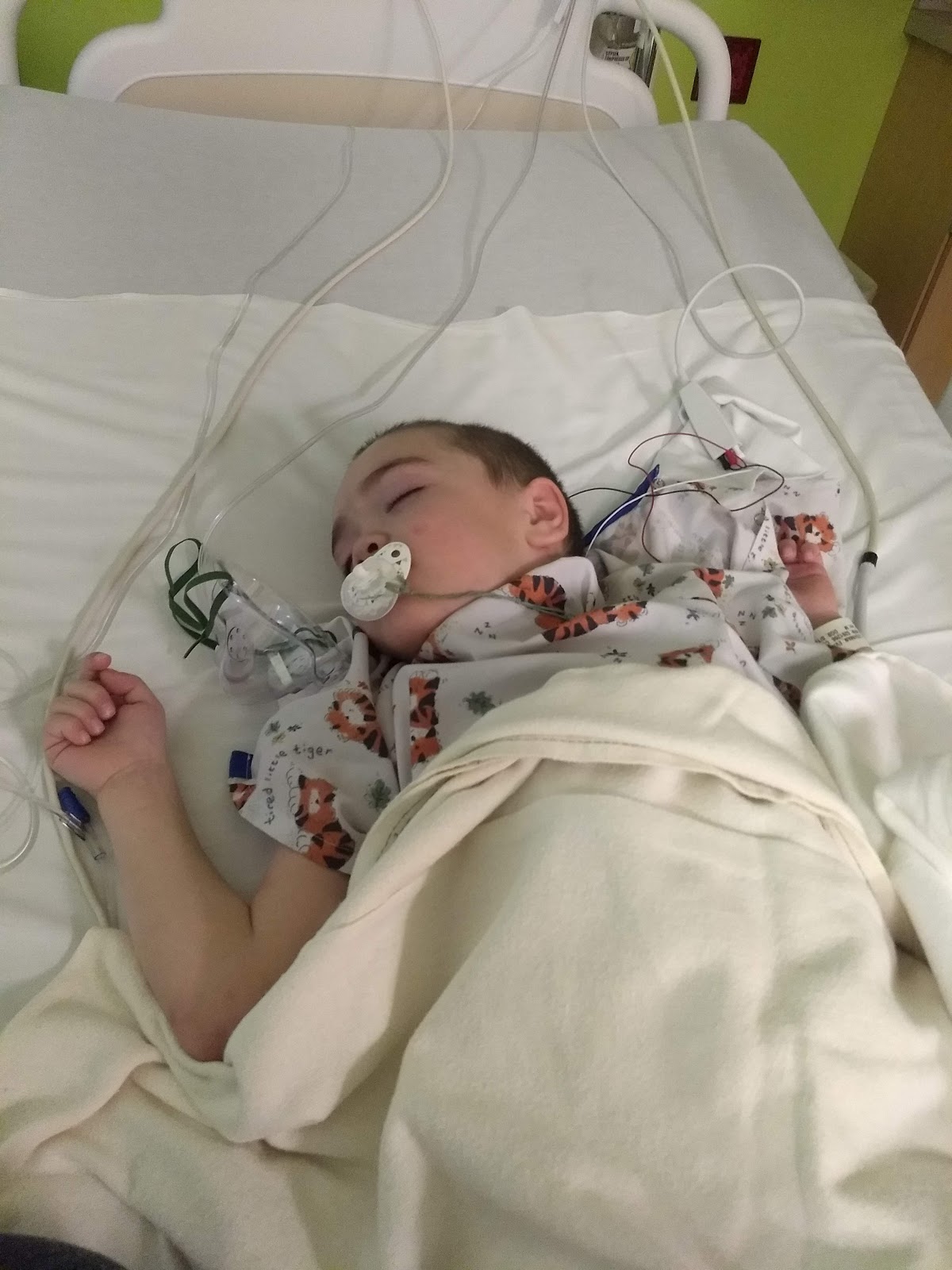 Gm1 Gangliosidosis Type 2 Our Experience Evan's GTube Surgery