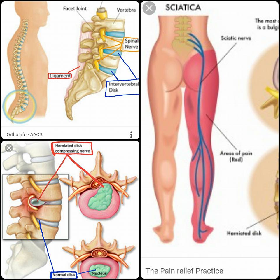 Silap Ketuk Boleh Pecah Tulang Belakang Dan Lumpuh Doktor Siakapkelis Media