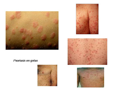 Psoriasis en gota