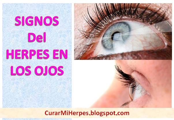 herpes-en-el-ojo-como-curar-tratamiento-natural-ocular