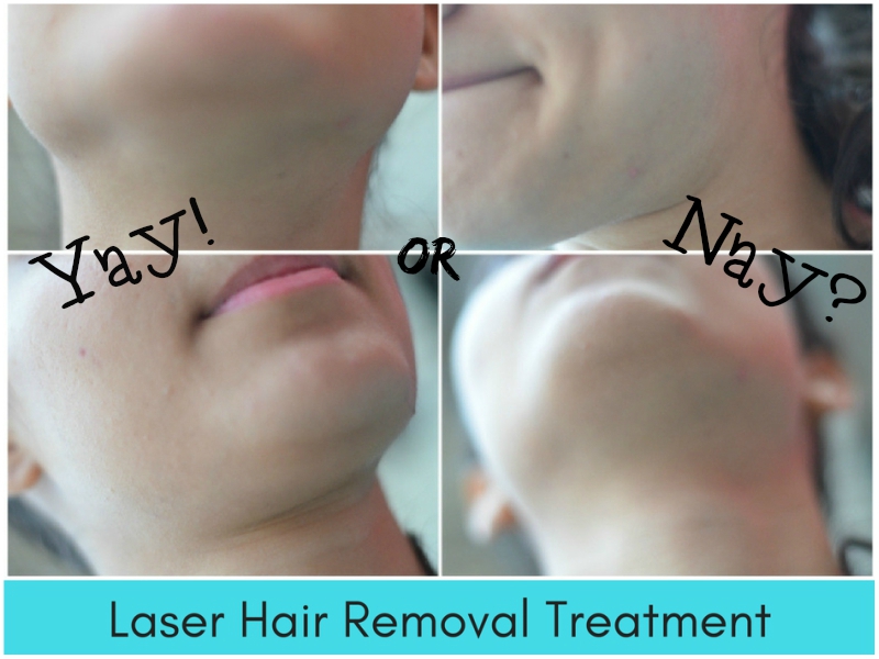Everything You Want To Know About Skin Hair Removal Laser