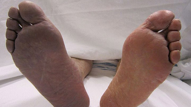 Braune Flecken Am Bein Diabetes Is Your Leg Trying To Tell You Something - zoy33ha