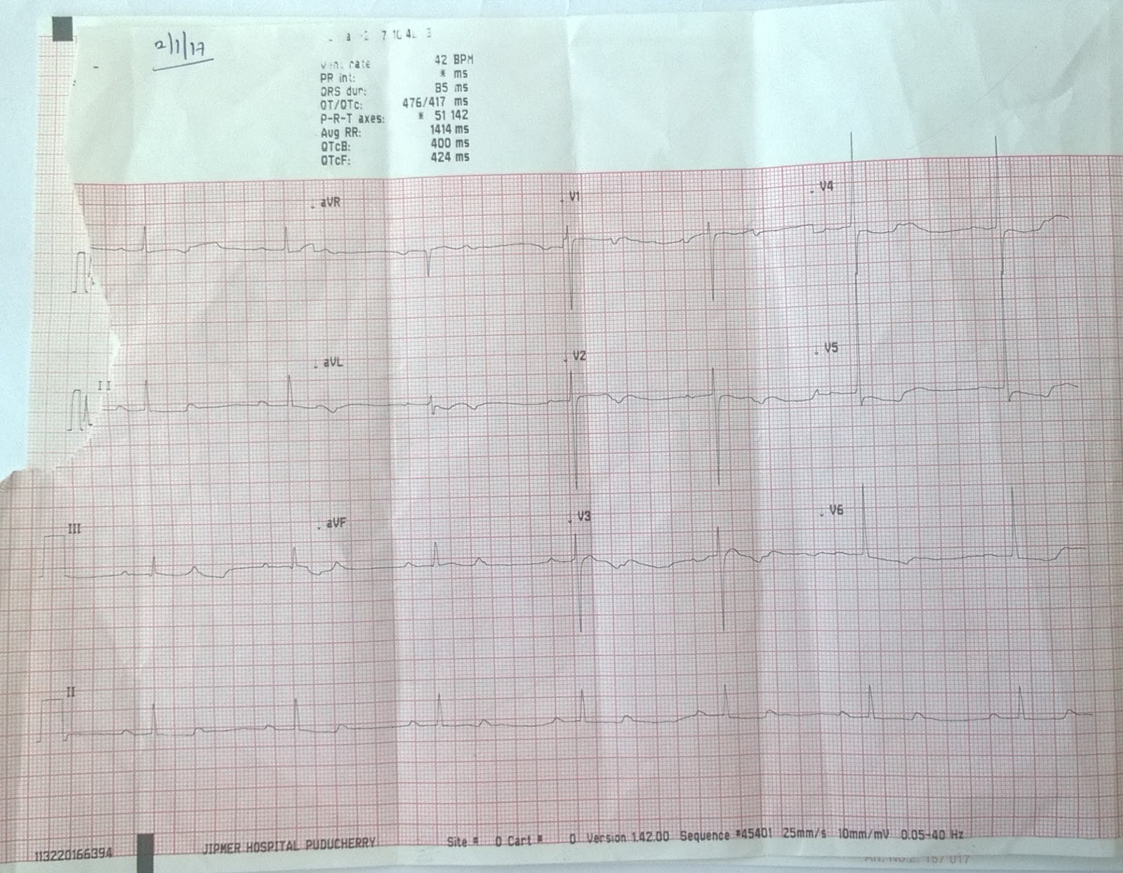 Cardiology window: ECG Complete heart block
