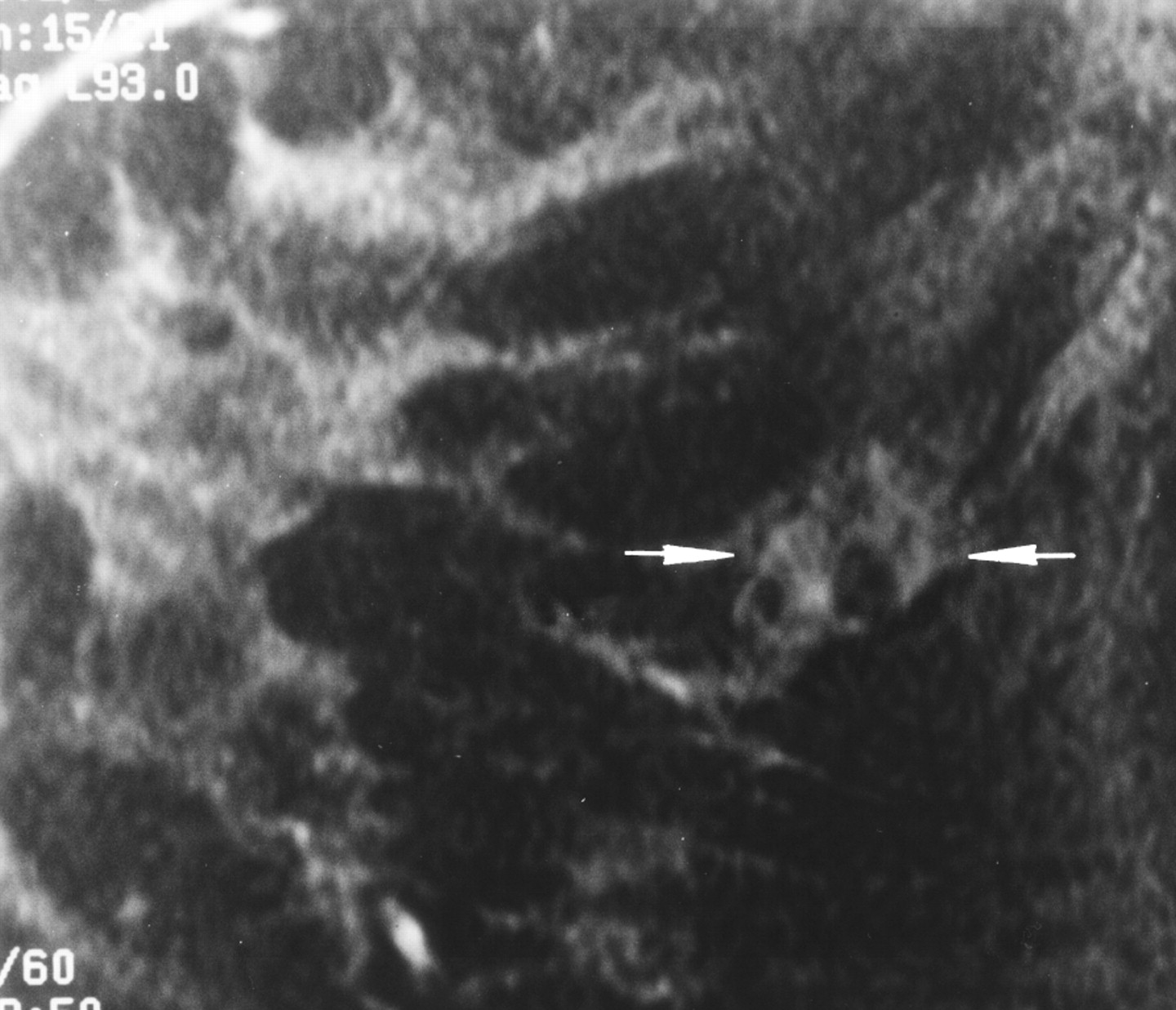 Фиброма в груди. Галактоцеле на маммографии. Фиброматоз молочной железы на УЗИ. Кистозная мастопатия УЗИ. Фиброзно-кистозная мастопатия молочных желез на УЗИ.
