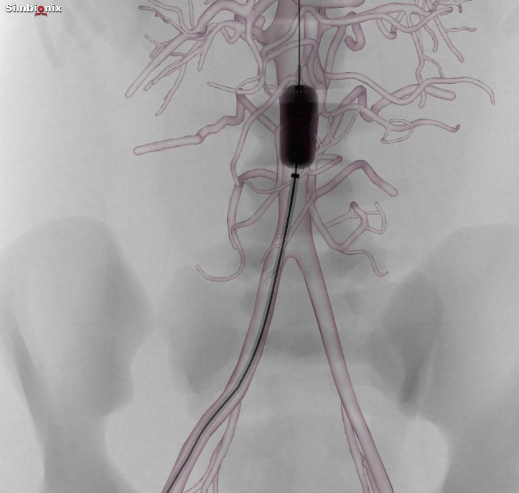 Resuscitative Endovascular Balloon Occlusion of the Aorta (REBOA)? by