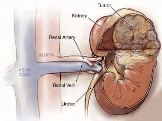 Kidney Care Capsule For Man Obat Herbal Gagal Ginjal 
