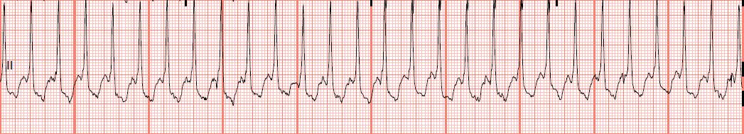 Float Nurse: EKG Rhythm Strips: Atrial Rhythms