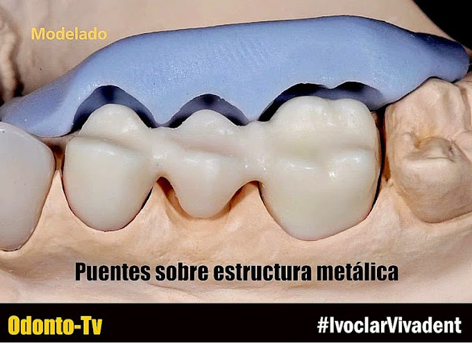 SR NEXCO PASTE: Puentes sobre estructura metálica - Ivoclar Vivadent