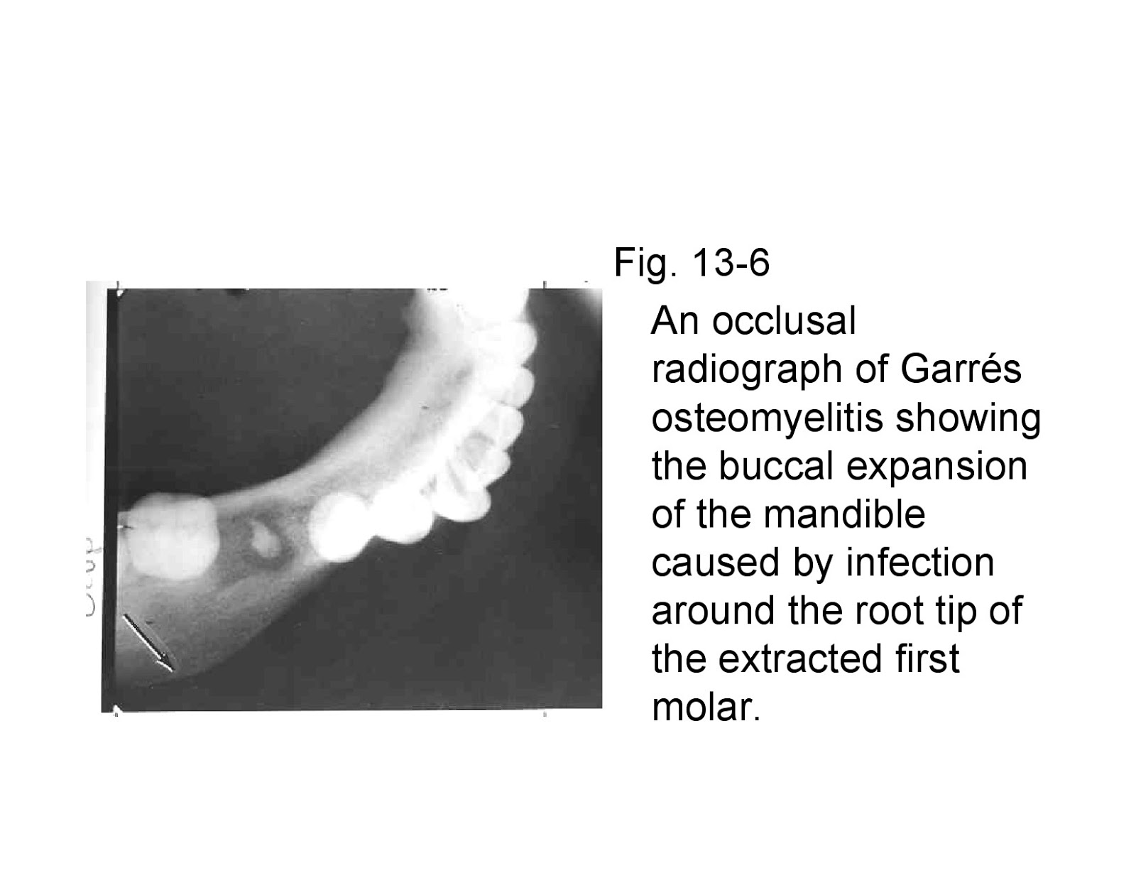 Dentistry and Medicine: Osteomyelitis-with Radiological features