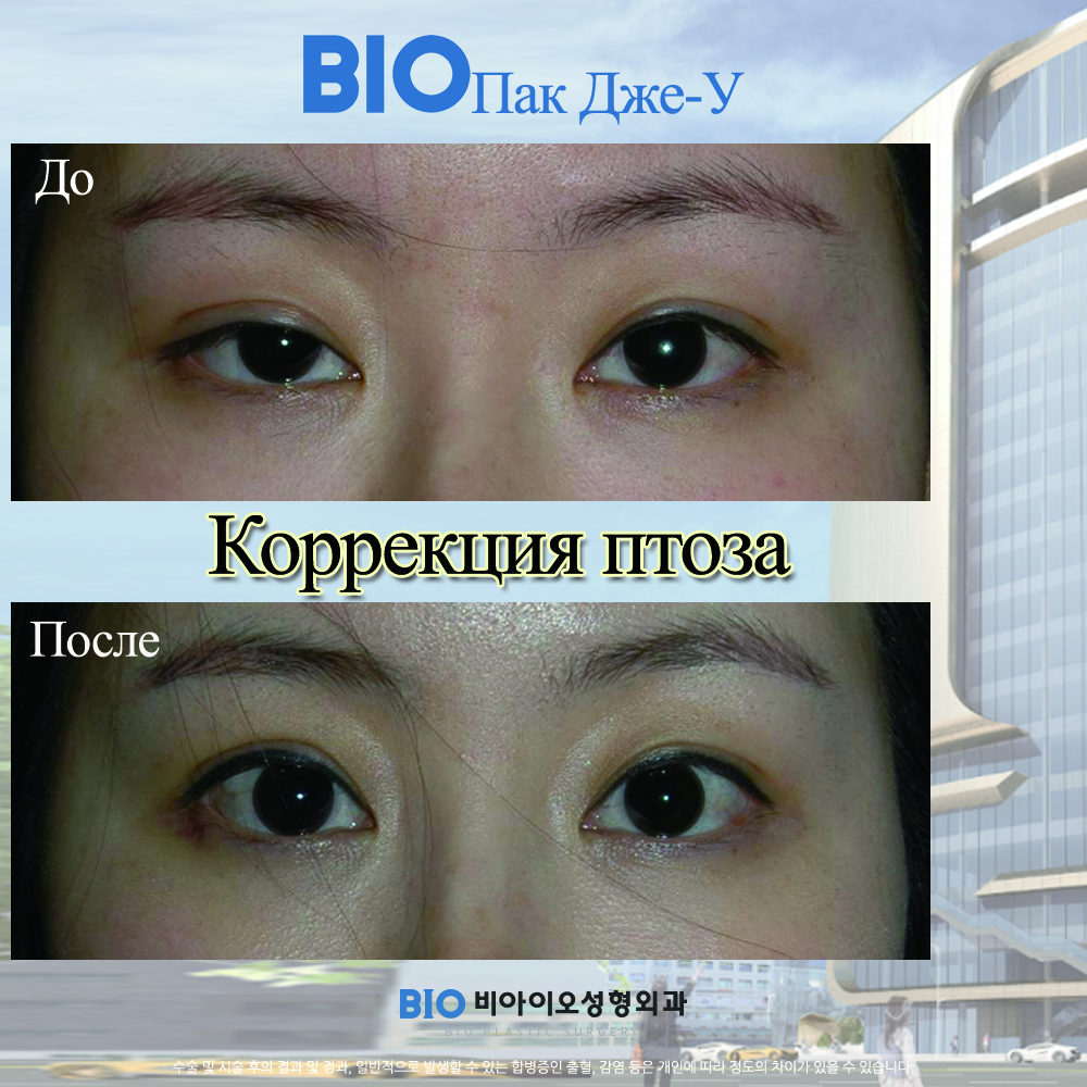 Что такое сангапури для глаз в косметологии. Операция сангапури. Сангапури блефаропластика Иркутск. Блефаропластика азиатских глаз. Блефаропластика верхних век азиатских глаз.