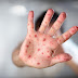 Ποιοι κινδυνεύουν από την ιλαρά και πώς θα προστατευθούν