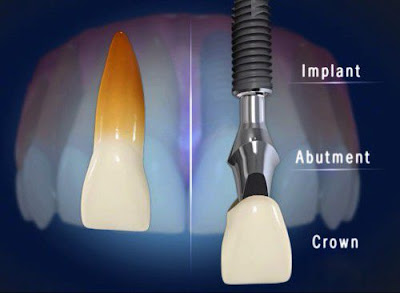 Quá trình cấy ghép implant như thế nào?